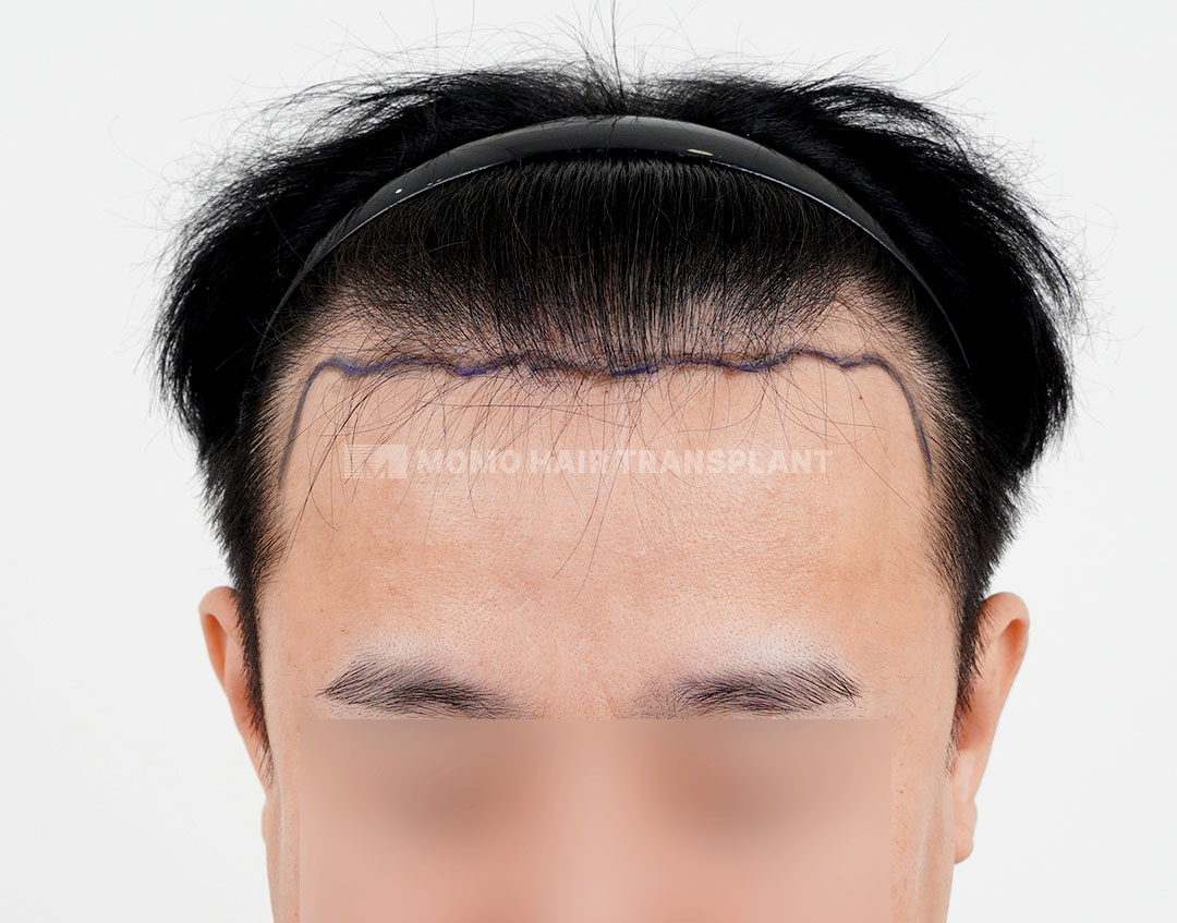 Before