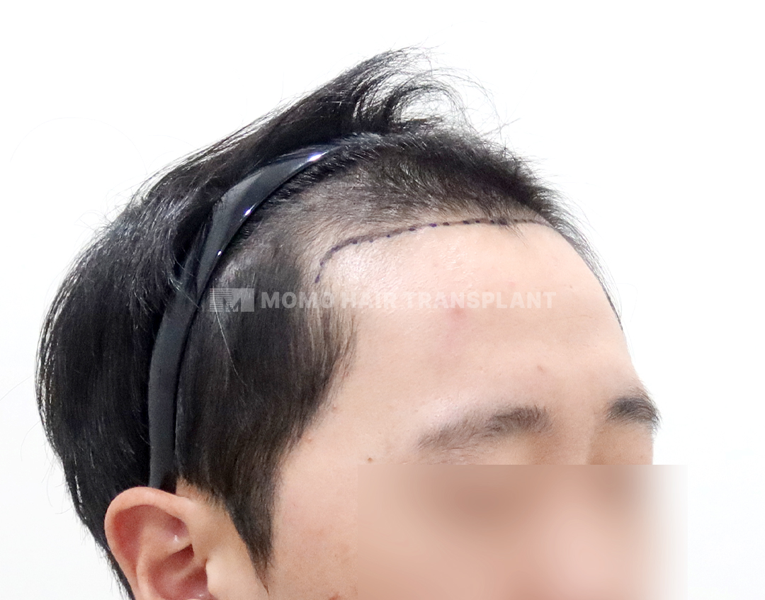 Before