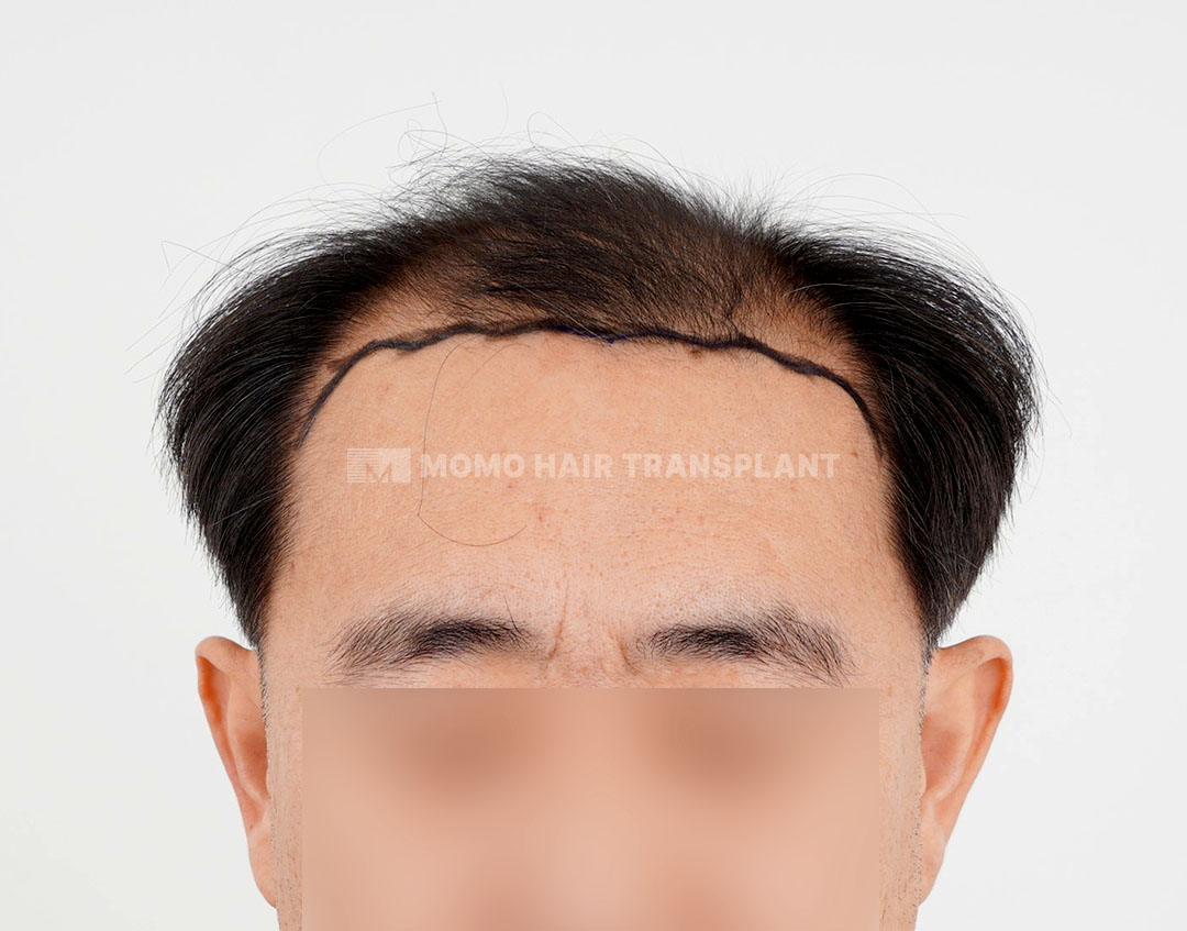 Before