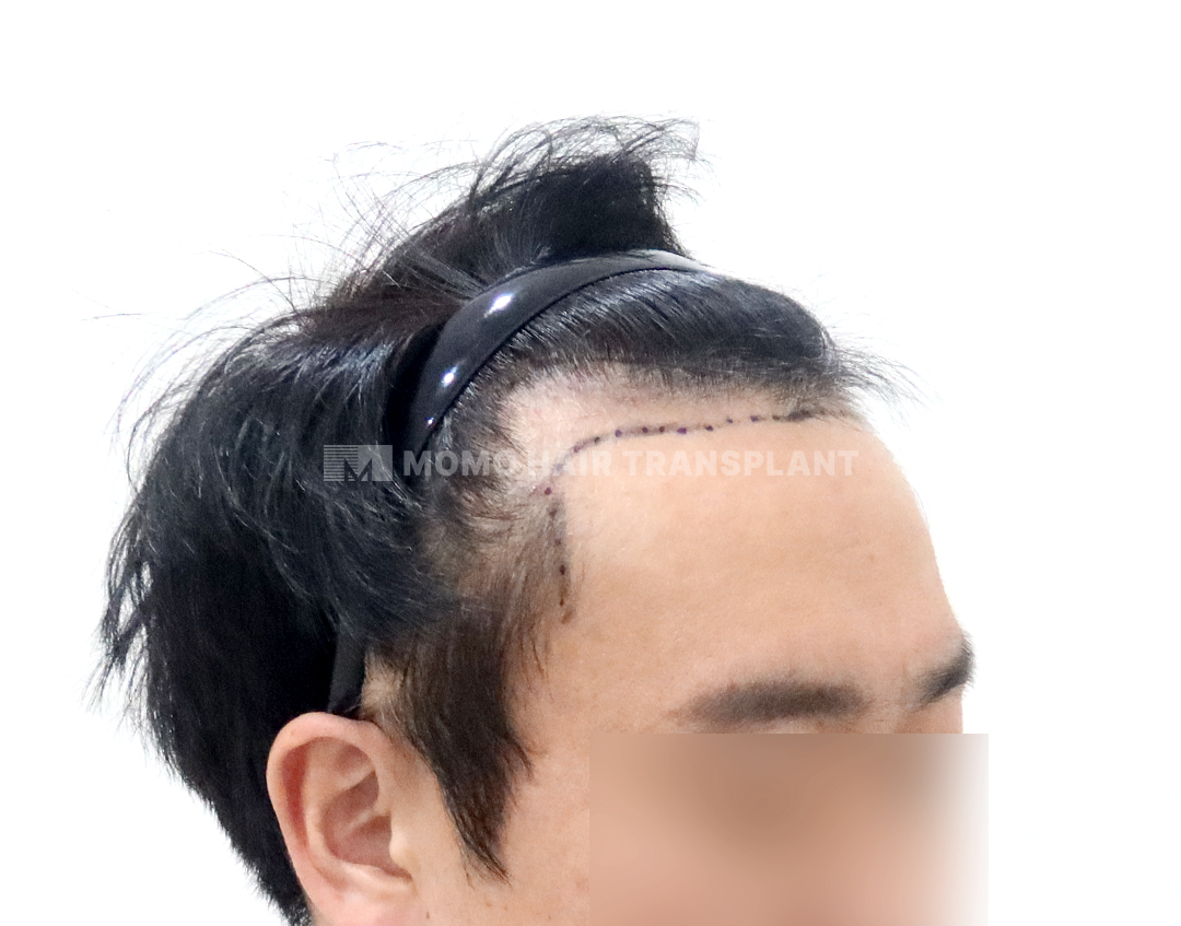 Before